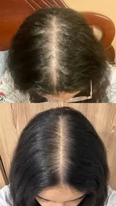 SkinLite Anti-Hairfall Shampoo 200ml | Biotin & Nutrient-Rich Formula | Strengthens Roots & Reduces Hair Loss